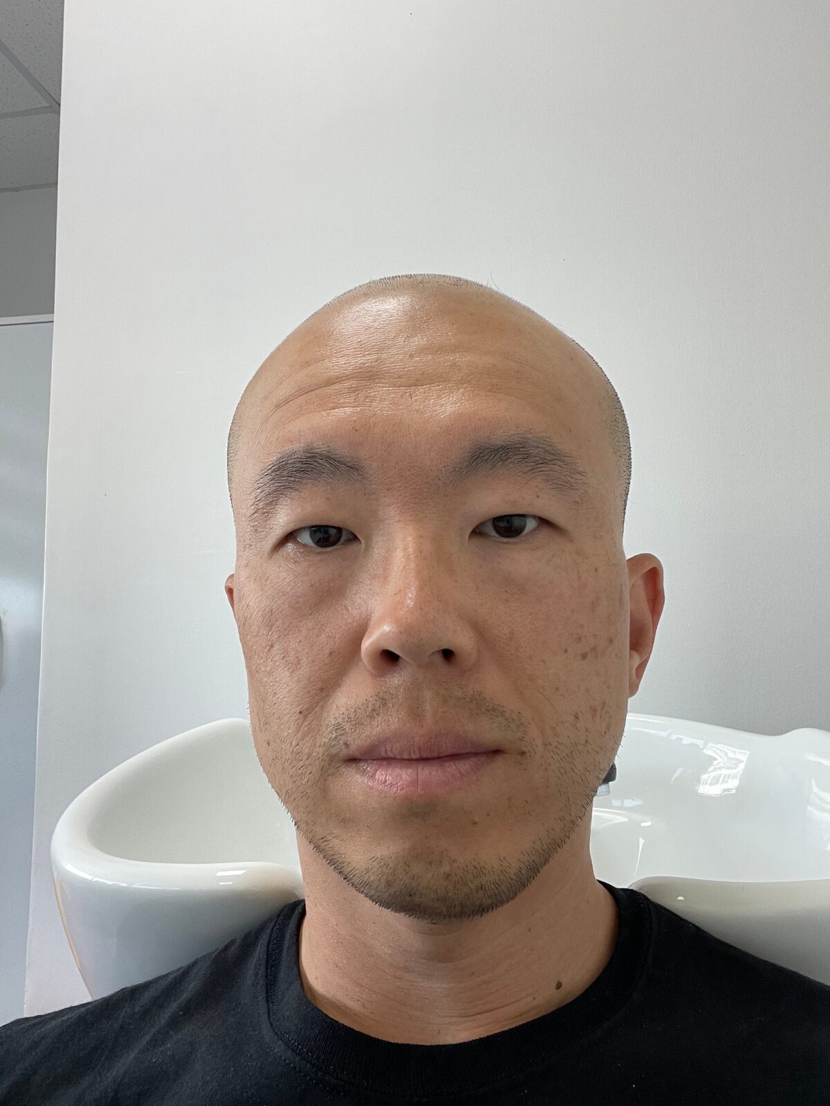 Joe, who got a hair transplant in Istanbul and later founded JetWell